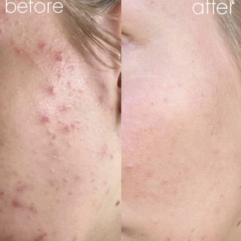 Before and after acne treatment: congested cheek
