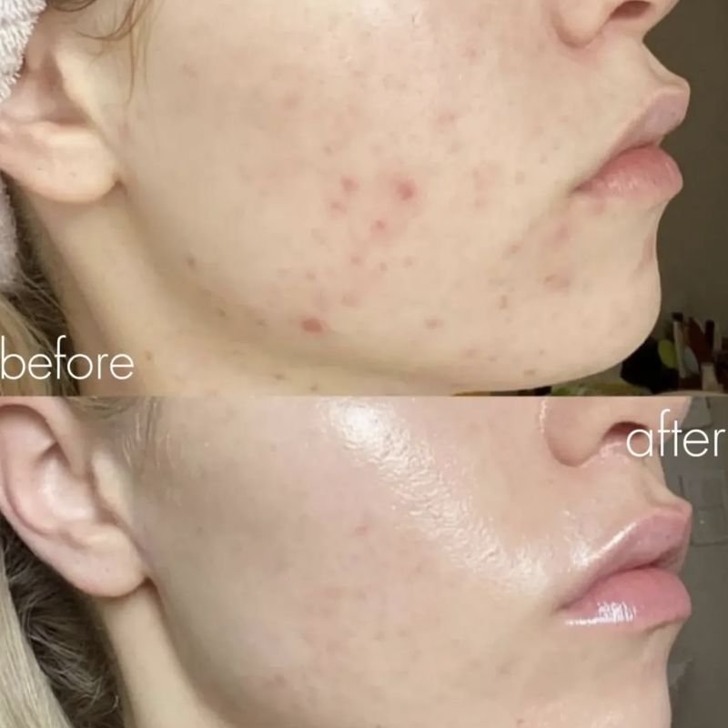 Before and after acne treatment: breakouts along the cheek and jaw