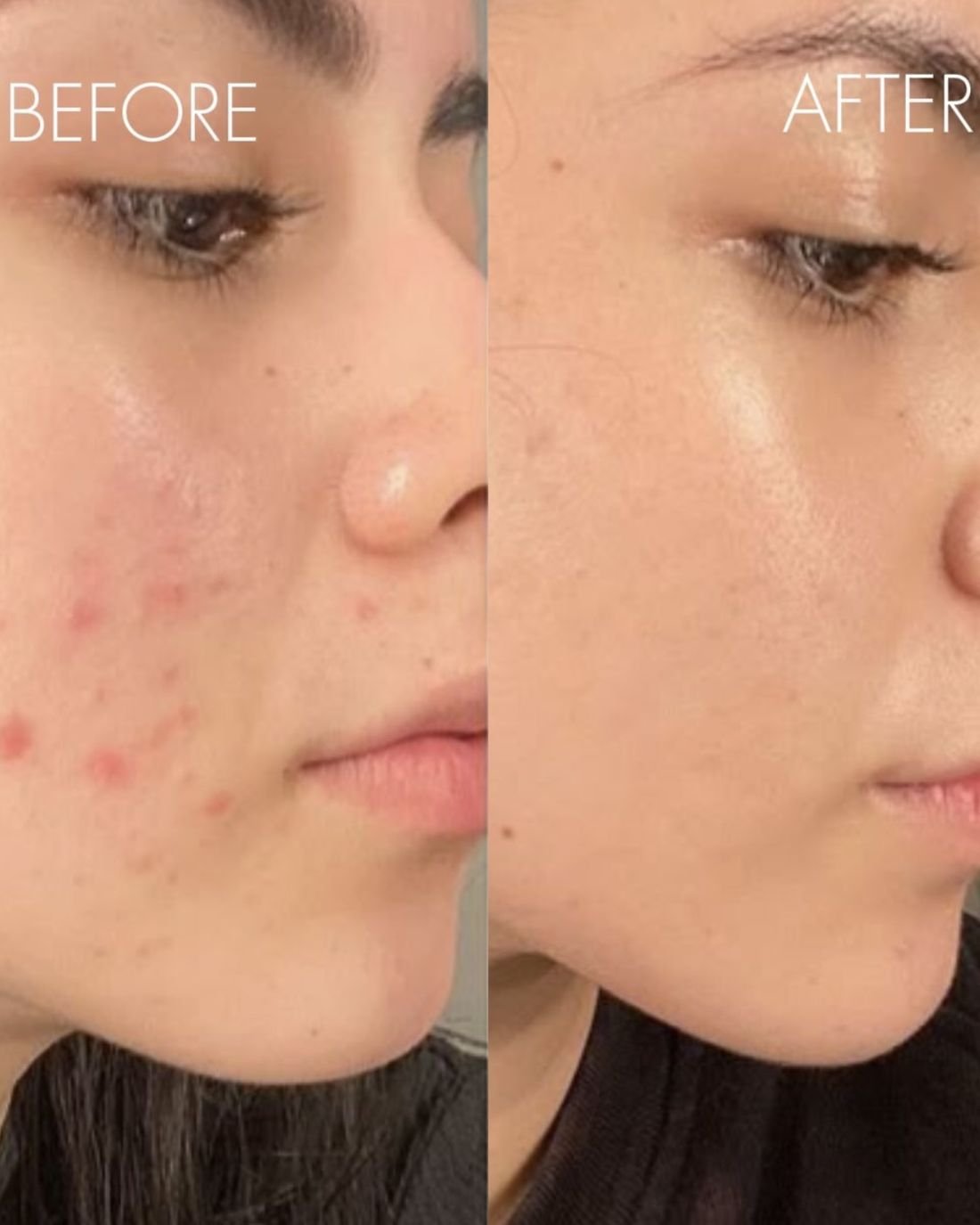 Before and after acne treatment: red, inflamed breakouts on the cheek