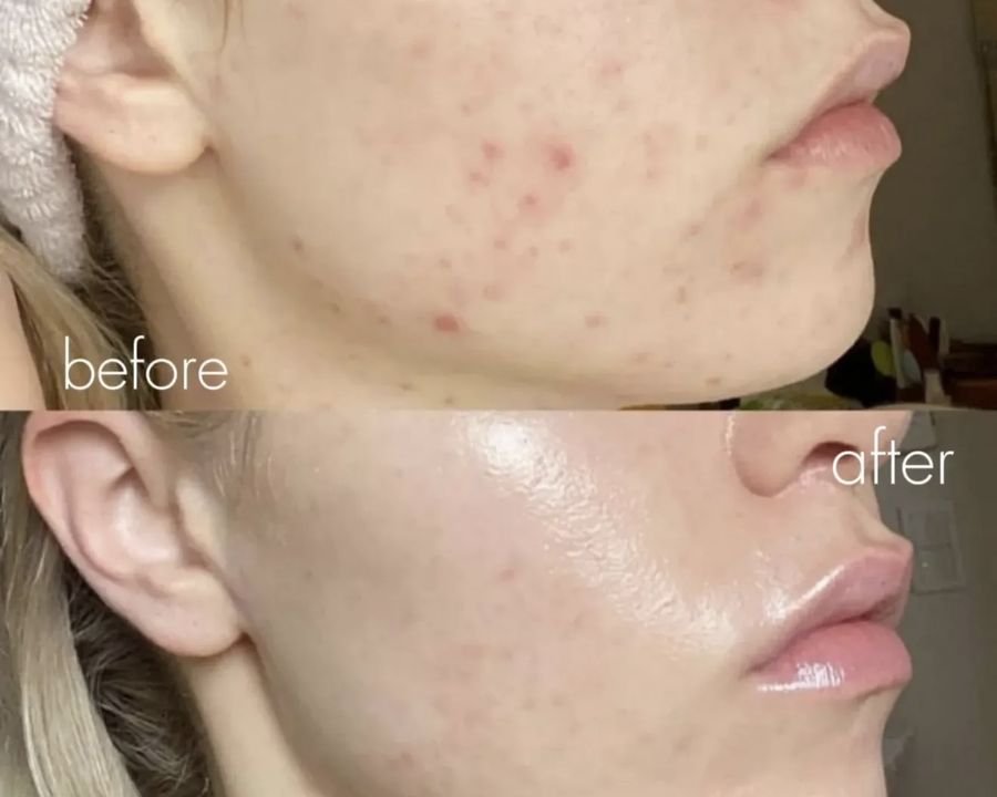 Before and after acne treatment: breakouts along the cheek and jaw